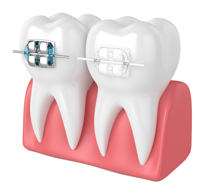 Clear braces Clear braces