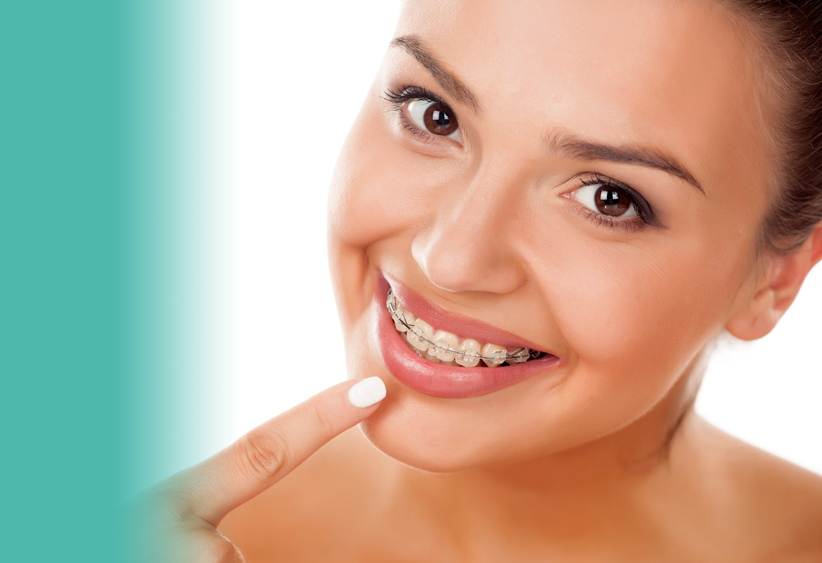 Clear braces Clear braces