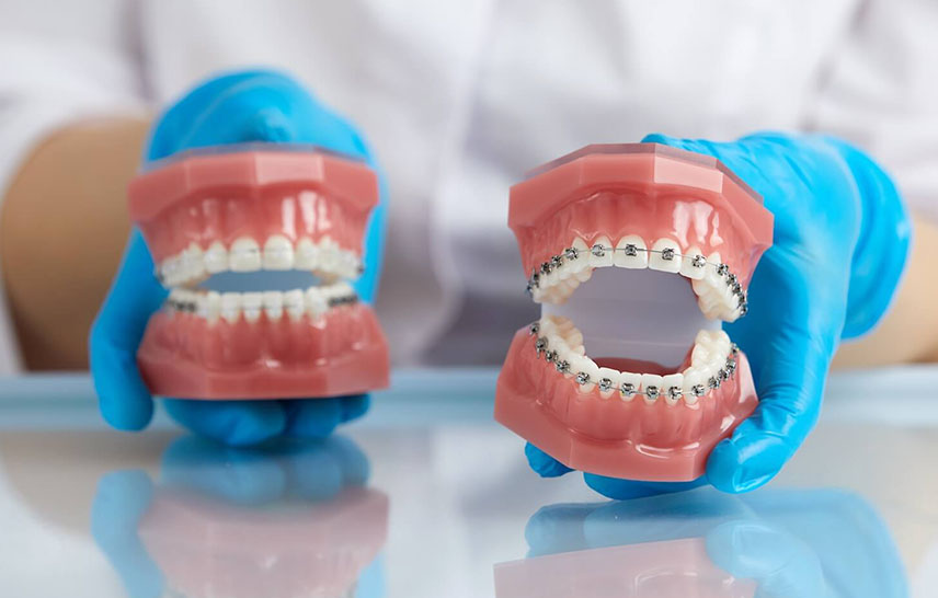 LightForce™ Clear Braces vs Metal Braces: Which Orthodontic Option Is Right for You? LightForce™ Clear Braces vs Metal Braces: Which Orthodontic Option Is Right for You?